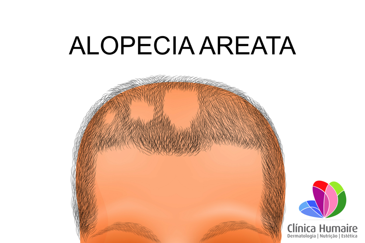 Alopecia Areata Fotos Imagens Videos E Tratamento Cl Nica Humaire