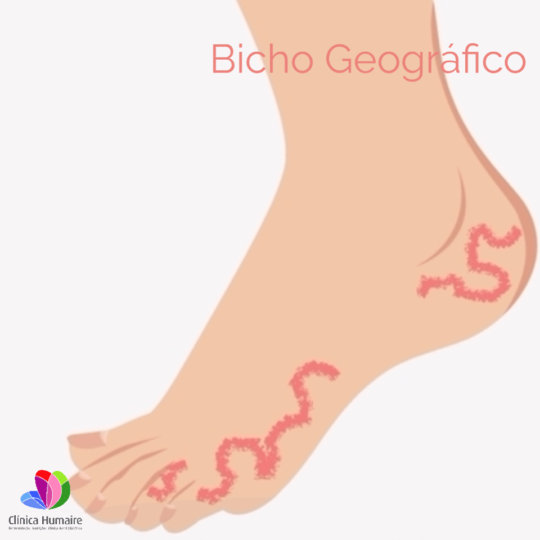 Bicho Geográfico Fotos Imagens Videos e Tratamento Clínica