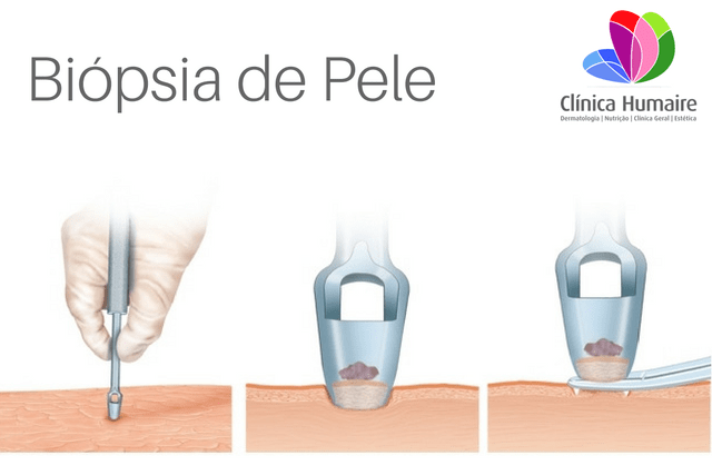 Biópsia De Pele Fotos Imagens Vídeos E Tratamento Clínica Humaire Dermatologia