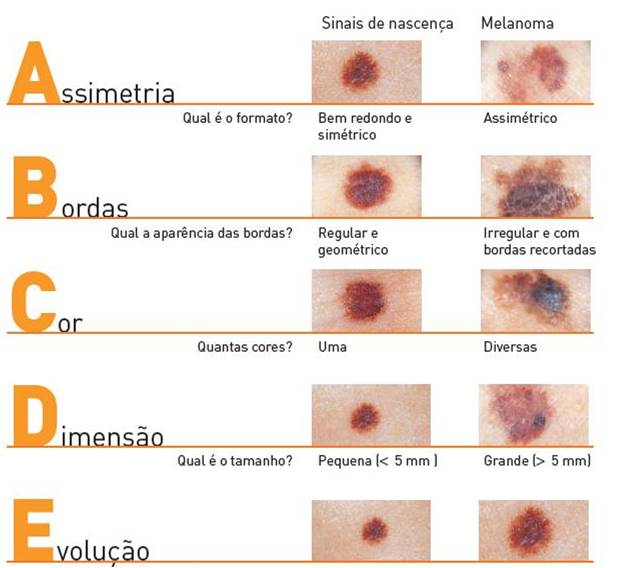 Câncer De Pele Fotos Imagens Vídeos E Tratamento Clínica Humaire Dermatologia Nutrição 