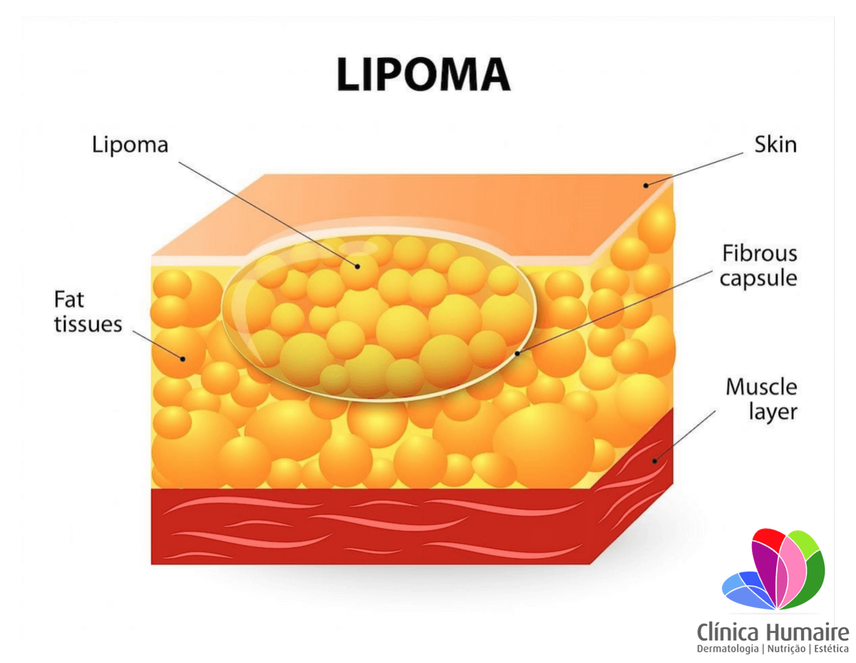 Lipoma Fotos Imagens V Deos E Tratamento Cl Nica Humaire Dermatologia Nutri O Bem Estar