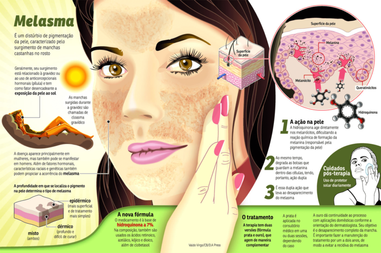 Melasma Fotos Imagens Vídeos E Tratamento Clínica Humaire Dermatologia Nutrição Bem 3797