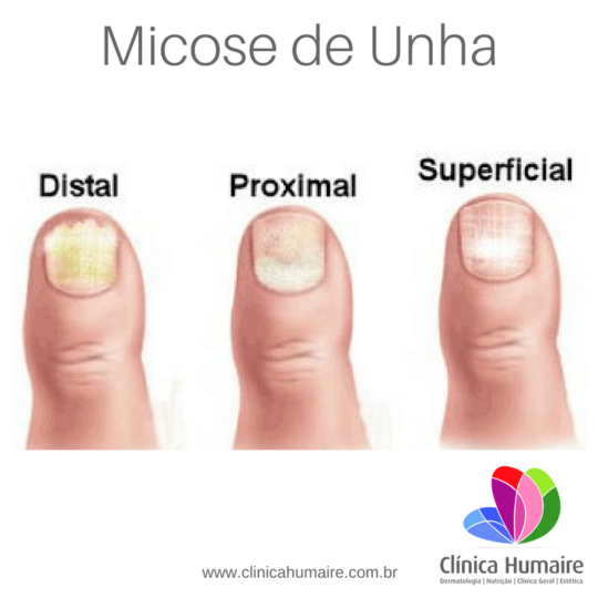 Micose Fotos Imagens Vídeos e Tratamento Clínica Humaire