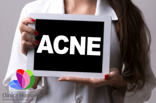 Acne - Clinica Humaire