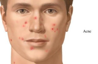 Acne - lesões na face - Clínica Humaire