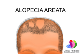 Alopecia Areata - Clinica Humaire