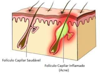 foliculo saudavel e inflamado acne - clinica humaire