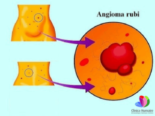 Angioma Rubi Clínica Humaire