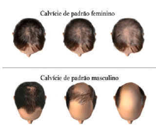calvicie-feminina-x-calvicie-masculina-clinica-humaire