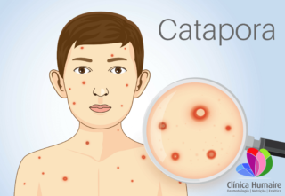 Catapora-ClinicaHumaire