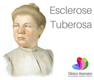 Esclerose Tuberosa Clínica Humaire