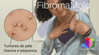Fibroma Mole - Clínica Humaire