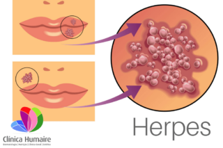 Herpes Clínica Humaire