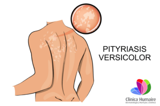 Pitiriase Versicolor - Clínica Humaire