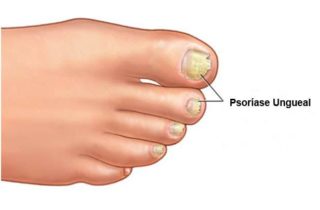 psoriase-ungueal-clinica-humaire