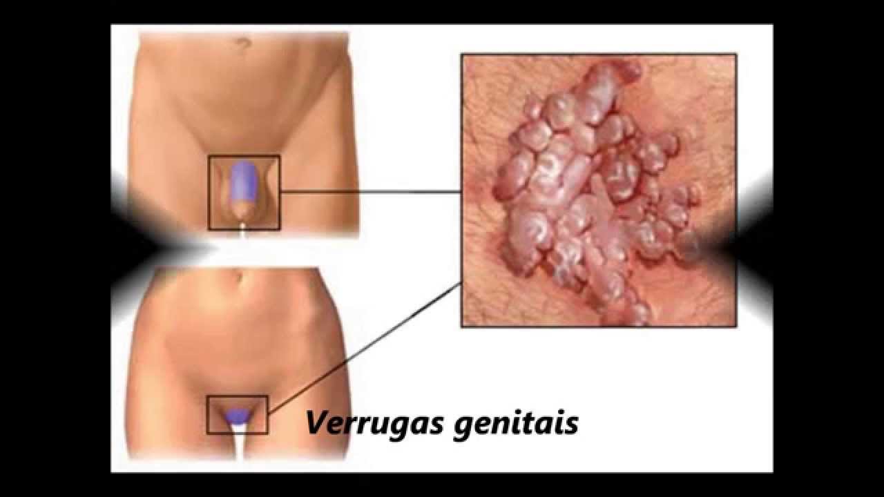 Hpv verruga genital tratamento, Hpv genital como tratar. Cum să câștige cura varicele