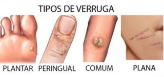 verrugas-tipos-clinica-humaire