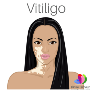 Vitiligo - Clínica Humaire