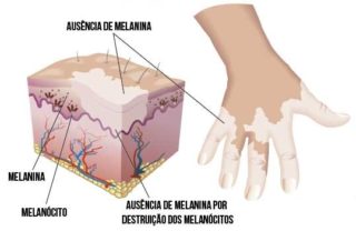 vitiligo-como-ocorre-clinica-humaire