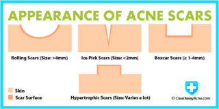 Tipos de cicatrizes de acne